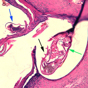 Cilt biyopsisinde uyuz akarı (işaretli)