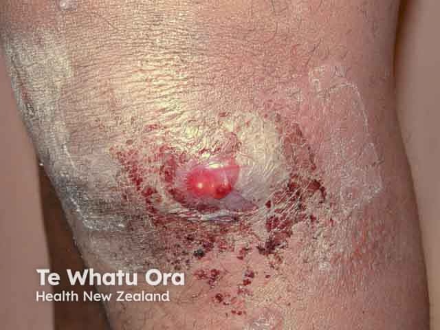 Uyuz enfekte lezyonları