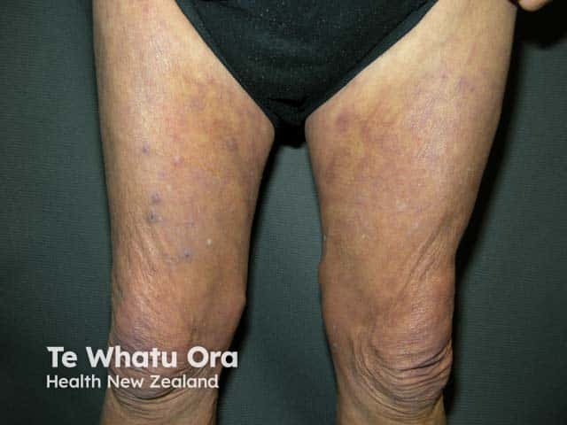 Kaşınmadan kaynaklanan likenifikasyon